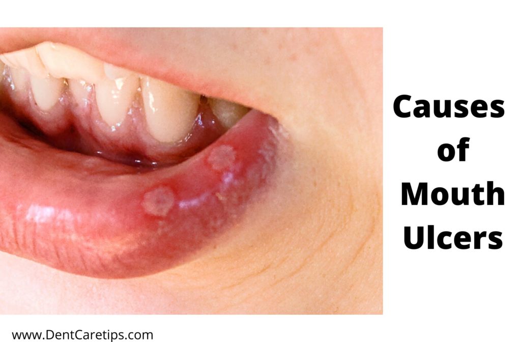 cause of mouth ulcers