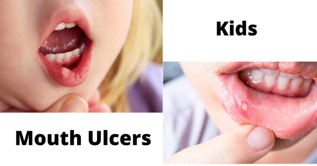 Mouth ulcers in child