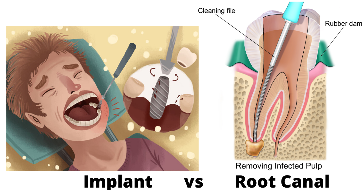 Root canal vs implant
