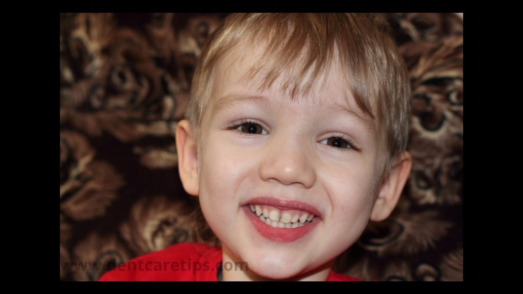 Discolored Baby Teeth